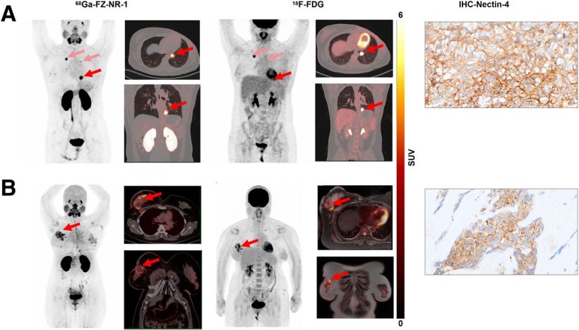 Novel radiotracer identifies TNBC biomarker