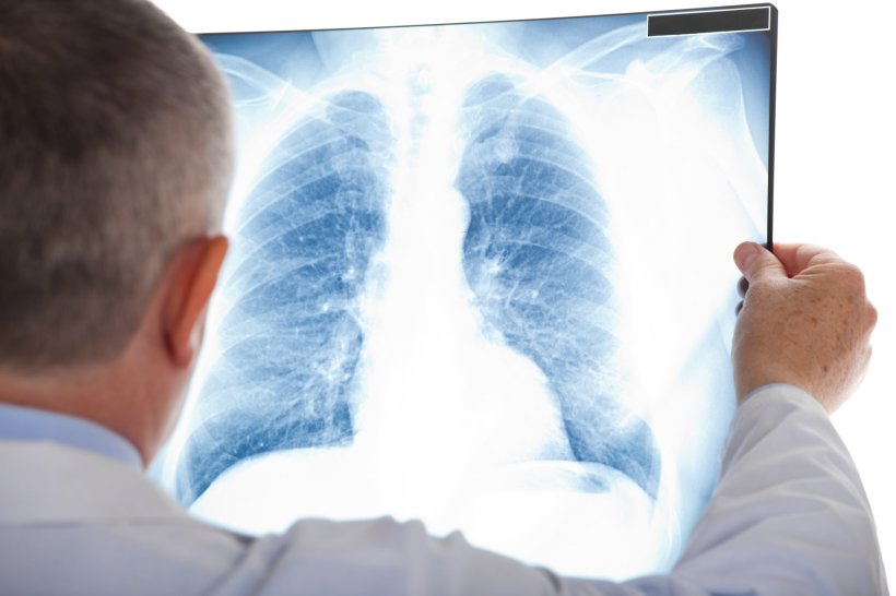 A doctor is looking at a chest x-ray scan